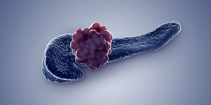 pancreatic cancer immunotherapy 
